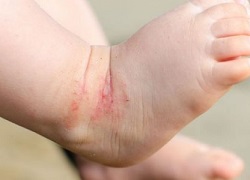 Висипання, свербіж, алергія, дерматит на шкірі у дитини – фото, опис, симптоми