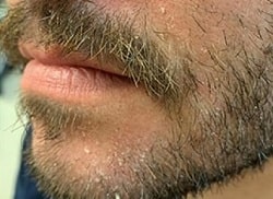 Грибок усов и бороды – фотографии, описание, симптомы микоза губ и подбородка