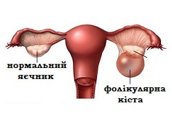 Кіста яєчника фолікулярна, кіста жовтого тіла, ендометріома