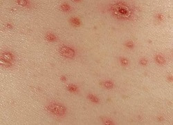 Чесотка, прыщи, потница, аллергия на коже – лечение и профилактика
