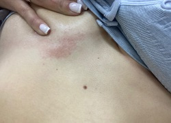 Фото опрелости под грудью у женщины, причины интертриго, факторы риска