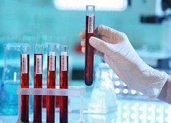 Біохімічний аналіз крові у Кривому Розі – АСТ та АЛТ, ГГТ, ЛФ, білірубін, білок