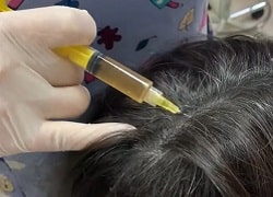 Плазмотерапия головы на Почтовом и Филатова, трихолог в Кривом Роге
