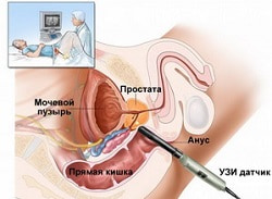 ТРУЗИ – УЗИ простаты в Кривом Роге, трансректальное исследование в урологии