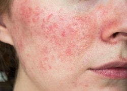 Почему воспаляется кожа – причины раздражения и аллергии, заболевания